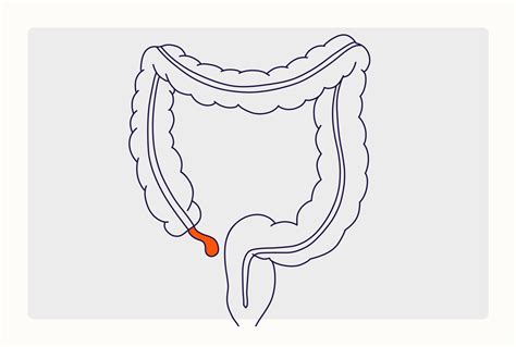 Image result for Different Types of Appendicitis