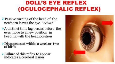 NEWBORN REFLEXES/ PRIMITIVE REFLEXES | PPTX
