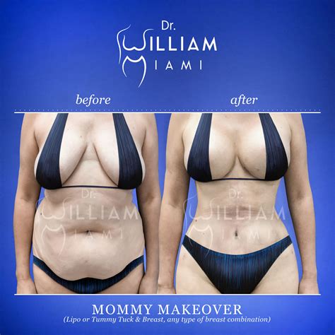 Mommy Makeover - Dr. William Miami