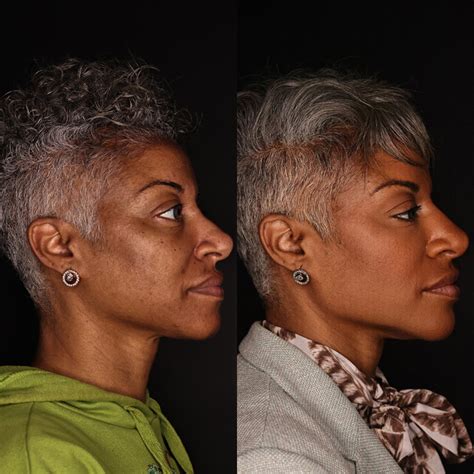 Image result for Thread Removal