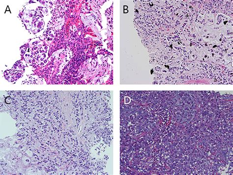 Frontiers | Poorly cohesive duodenal carcinoma mixed with signet ring cell carcinoma with ...