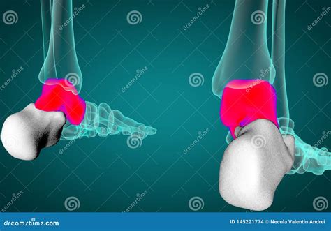 Talus Fracture And Broken Leg With Swelling Ankle Symptom Outline Diagram Vector Illustration ...