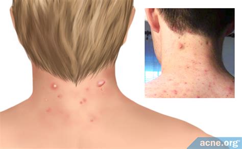 Image result for Exploding Back Zits