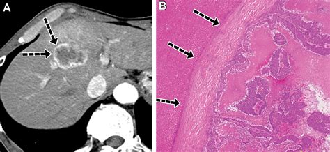 Liver Metastases: Correlation between Imaging Features and Pathomolecular EnvironmentsRadioGraphics
