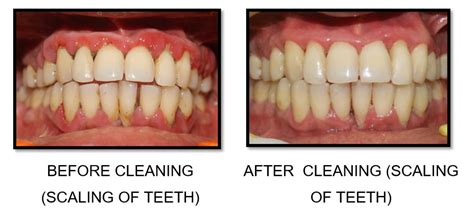 Teeth Scaling Procedure | News | Dentagama