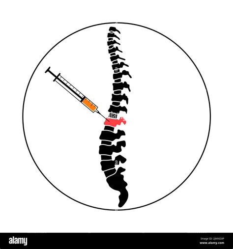 Image result for Spinal Injection Coding Videos