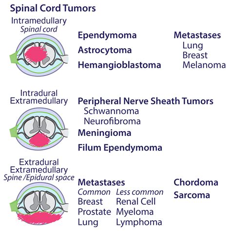 Clinical Pathology Glossary: Spinal Cord Tumors | ditki medical & biological sciences