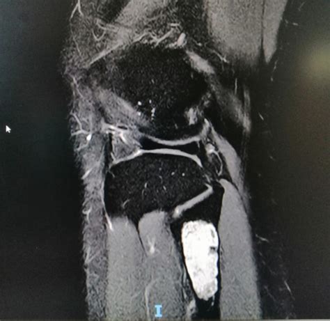 Image result for Exploding Massive Knee Abscess