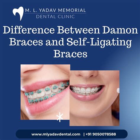 Damon Braces Logo Difference Between Damon Braces And Self Ligating