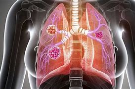 Image result for lung disease 一切肺病