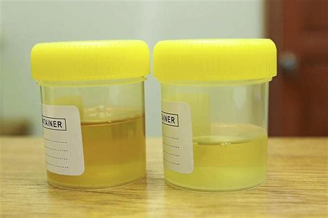 Cloudy Urine During Pregnancy | Parentinghealthybabies.com