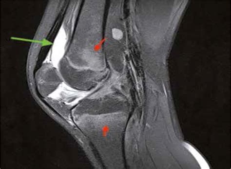 Rheumatoid Arthritis Knee Mri