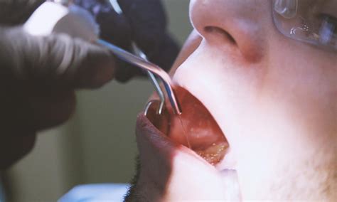 Infected Tooth Extraction Procedure 的图像结果