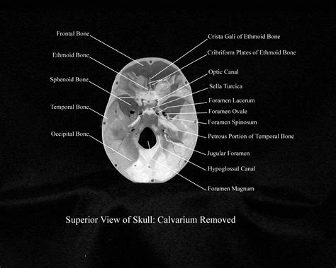 Superior Skull Anatomy
