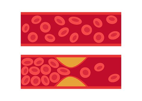 Normal and cholesterol-blocked artery. Blood clot, thrombus ...