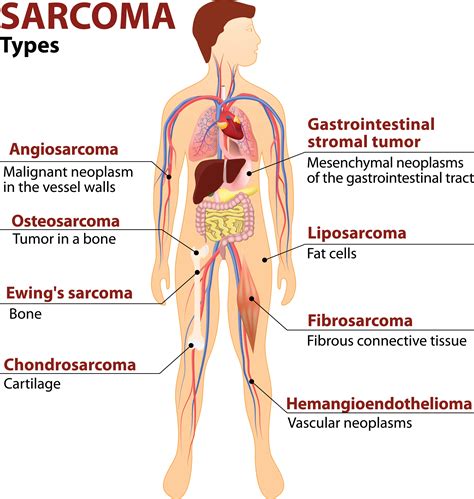 Sarcoma - A Complex, Aggressive Cancer: 4 Main Types | Parkway Cancer Centre Singapore