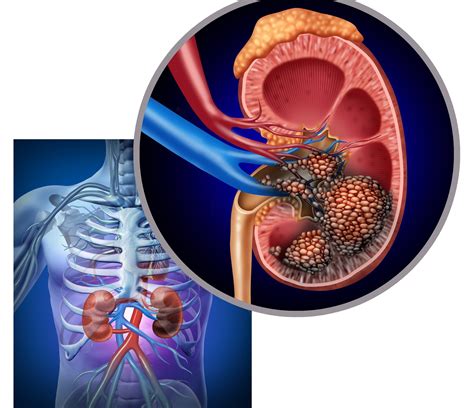 WHAT IS KIDNEY CANCER: TYPES, SYMPTOMS, STAGES, AND MORE - Chiid Health