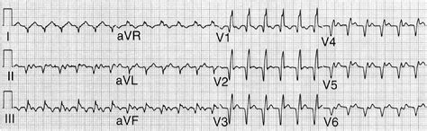 Image result for AFib Detection Algorithm