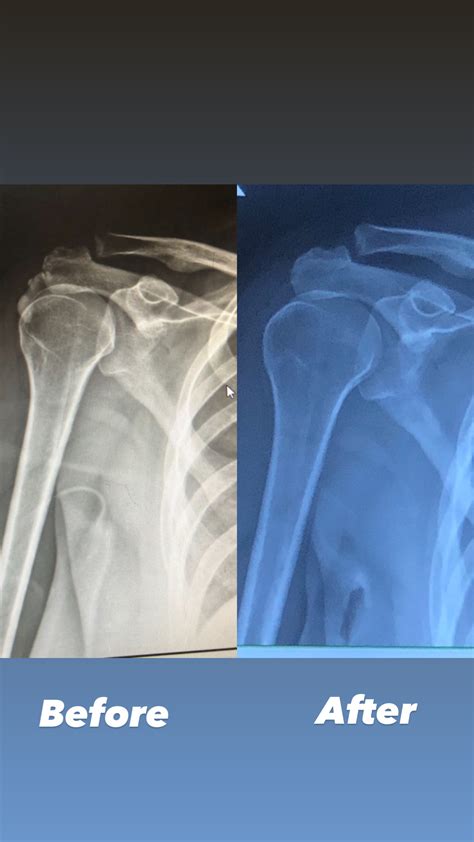 Shoulder X Ray Calcium Deposit at Timothy Stump blog
