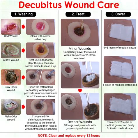 Bed Sores And Treatment