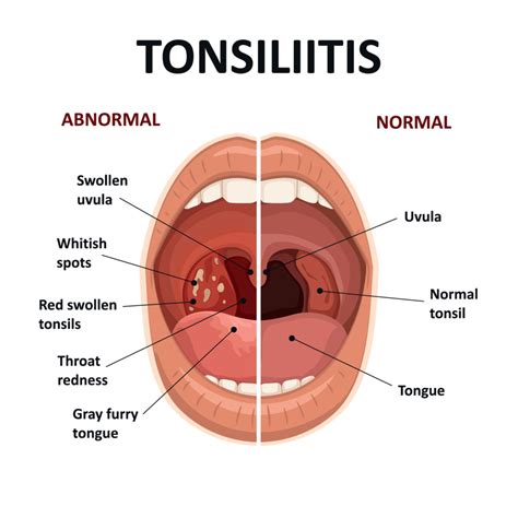 Where Is Tonsillitis Located