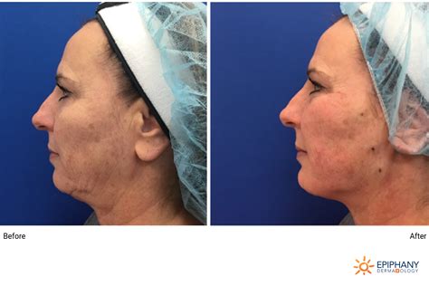 Image result for Thread Lift Problems