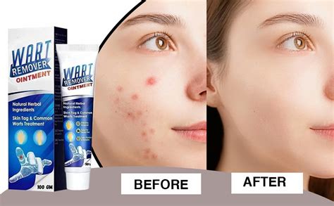 SEINON'S Warts Remover Cream Extract Skin Face Tag Extract Corn ...