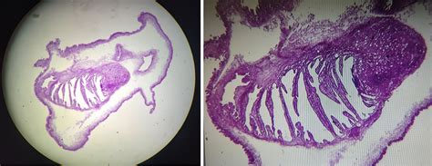 Cheek cysticercosis - to treat or not to treat | Pediatric Oncall Journal