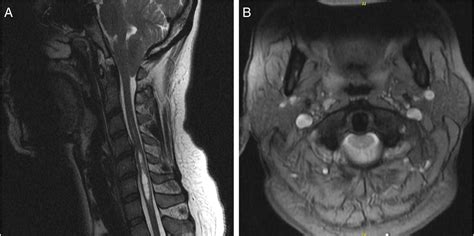 Chiari malformation - Clinical Tree