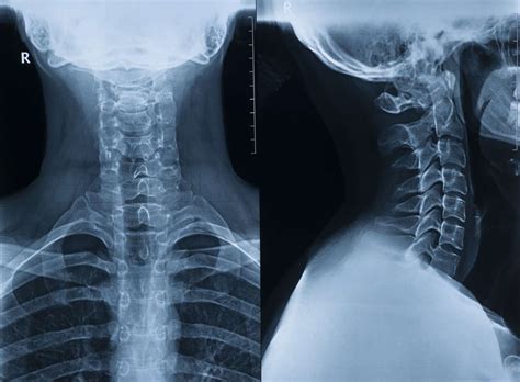 Cervical spine abnormal x ray - coffeeklim