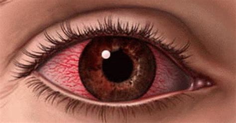 Cara Mengobati Sakit Mata Merah dan Belekan - Ilmu Tip Trik