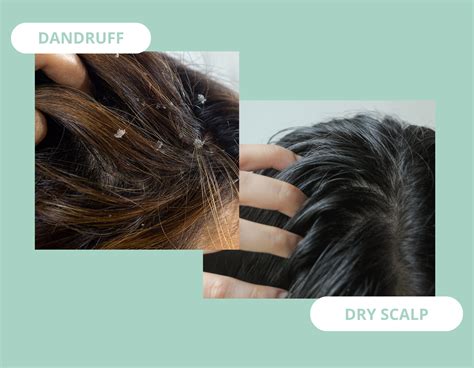 Dandruff vs Dry Scalp l The Comprehensive Comparison & Treatments ...