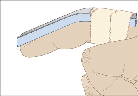 Image result for Finger Dislocation Reduction