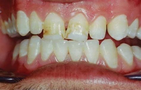 Oral bacterial community changes tied to severe dental fluorosis, Study ...