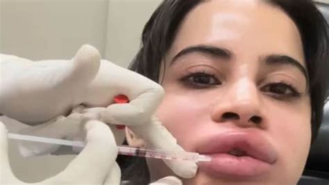 Uorfi Javed ने हटवाए अपने लिप फिलर्स, जानिए Lip Fillers के फायदे और ...