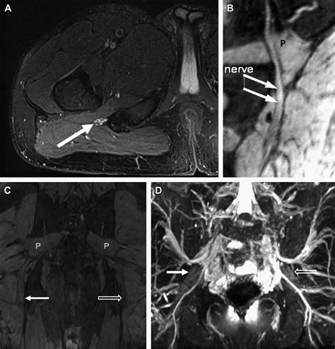 Magnetic Resonance Neurography of the Pelvis and Lumbosacral Plexus - Neuroimaging Clinics