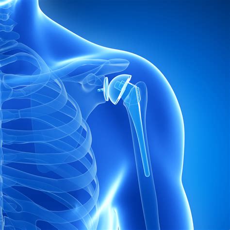 Shoulder Replacement Surgery (Full and Partial) - West Coast Orthopedics