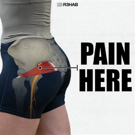 Hip impingement exercises – Artofit