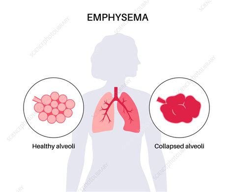 Image result for Emphysema Example