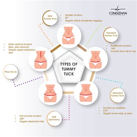 Tummy Tuck (Abdominoplasty) & Its 5 Types | Dr. Cengizhan Ekizceli
