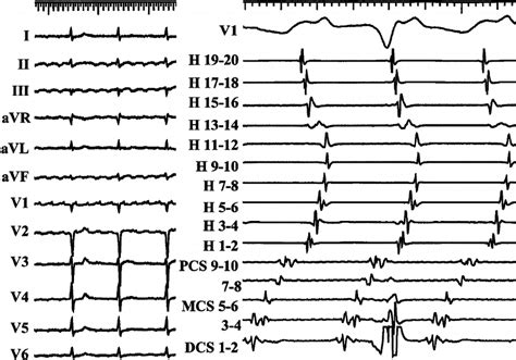 Image result for Atrial Flutter ECG Pattern