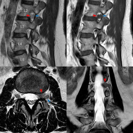 Image result for Foraminal Disc Extrusion