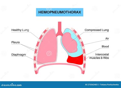 Illustration Of Pneumothorax Hemothorax And Hemopneumothorax Stock