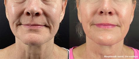 Before and After Miraculous Morpheus 8 Skin Treatment
