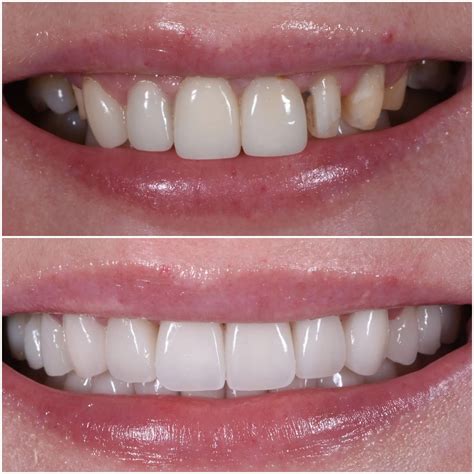 NYC Teeth Bonding | Upper East Side Cosmetic Dental Bonding