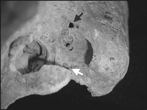 Image result for Temporal Bone Mastoid Process