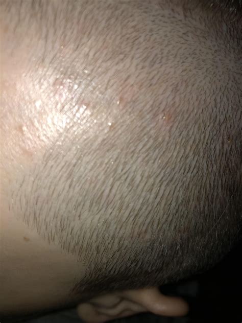itchy painful red bumps on scalp with dandruff, what condition is this and how do i treat/reduce ...