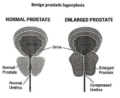Prostate Gland: Miscellaneous - Medical Science Optional Notes for UPSC ...