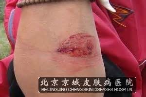 毒蛇咬伤怎么处理呢_蛰咬伤_北京京城皮肤医院(北京医保定点机构)
