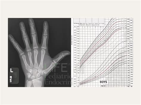 When Do Growth Plates Close?